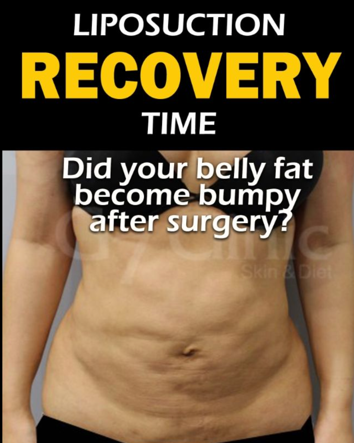 Liposuction Post-Op Recovery: Lymphatic Drainage Therapy